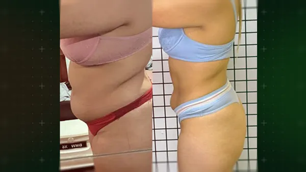 Antes e Depois