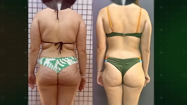Antes e Depois