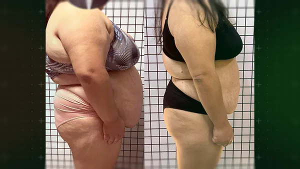 Antes e Depois
