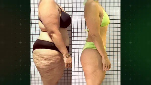 Antes e Depois